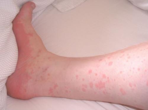 аллергия на ноге на царапины