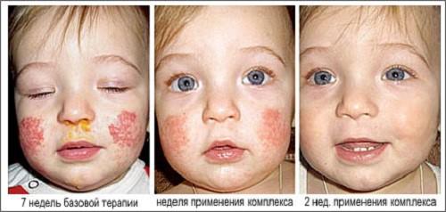 этапы лечения дерматита у девочки