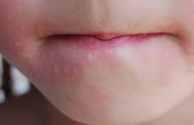 аллергия вокруг рта