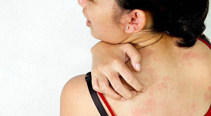 аллергия на спине