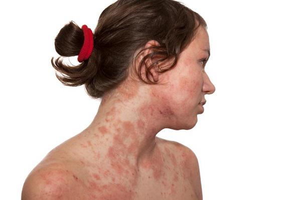 аллергия на лице и шее