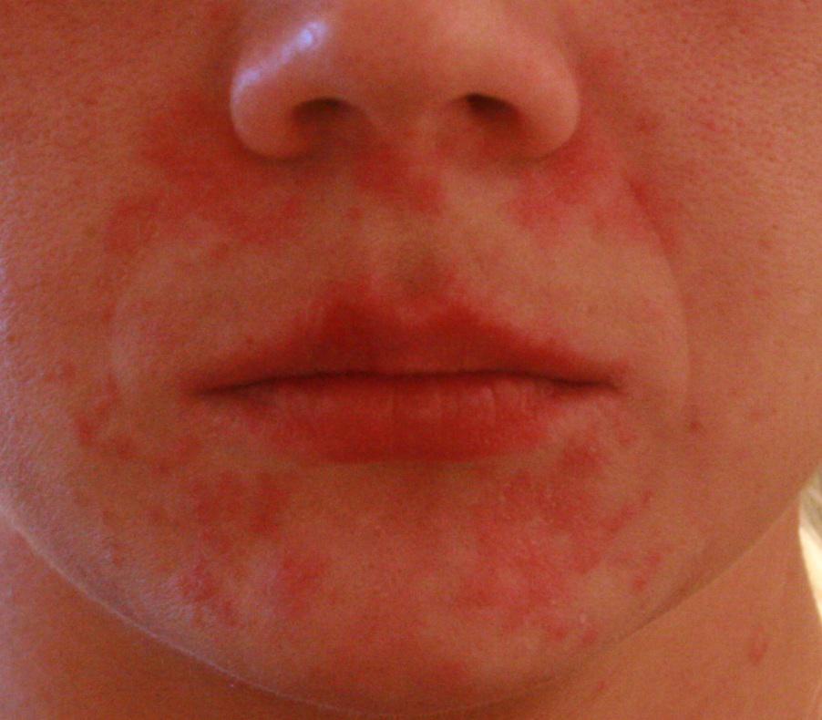 аллергия вокруг рта