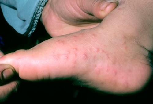 аллергия на ноге