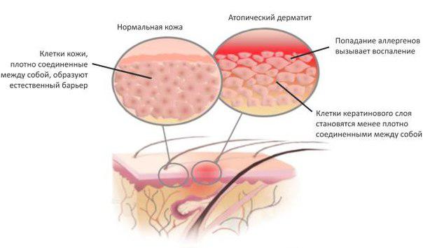 схема появления дерматита