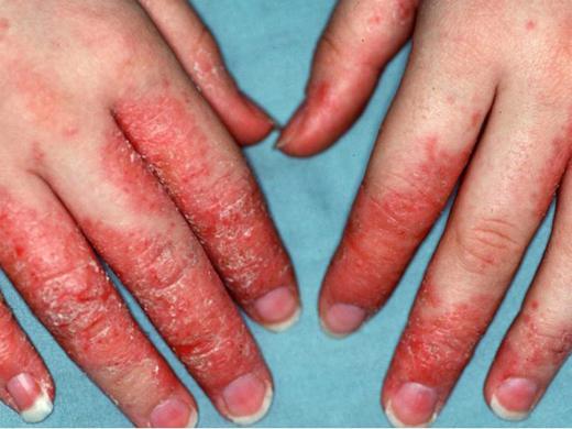 Тяжелая форма дерматита на пальцах