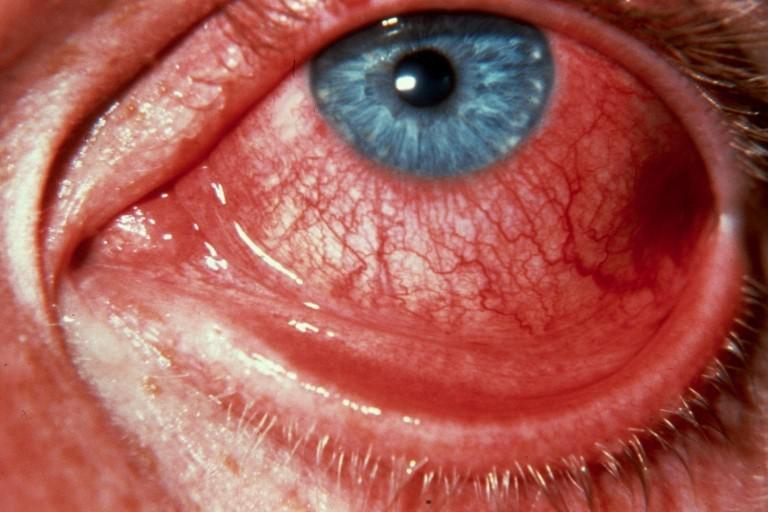 красный глаз из-за отека конъюнктивы