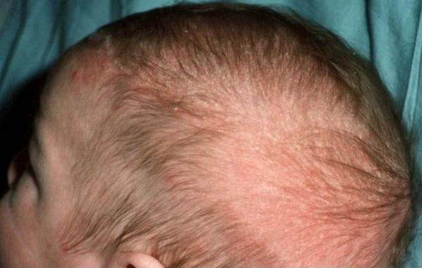 себорейный дерматит у малыша на голове