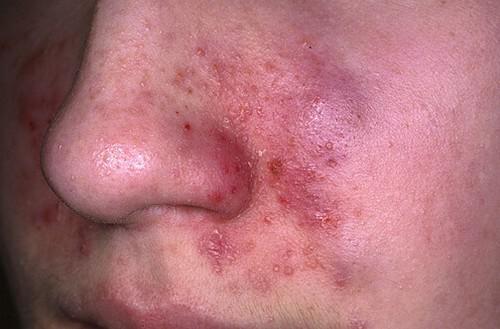 аллергические поражения на лице