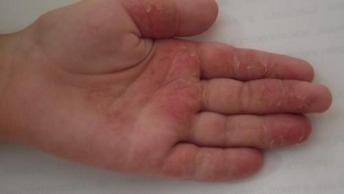 начальная стадия дерматита на руке