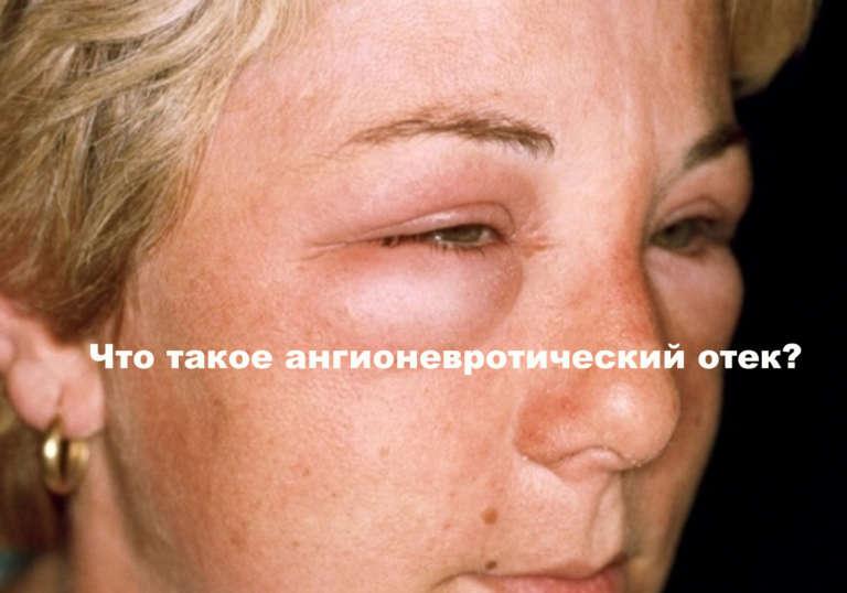 Ангионевротический отек: симптомы и лечение на лице, и губах
