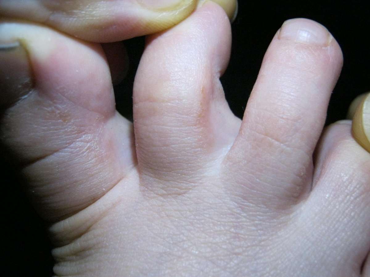 Жить здорово грибок на ногах между пальцами лоцерил для лече.
