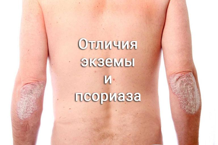 С какими болезнями путают псориаз Болезнями путают какими псориаз с