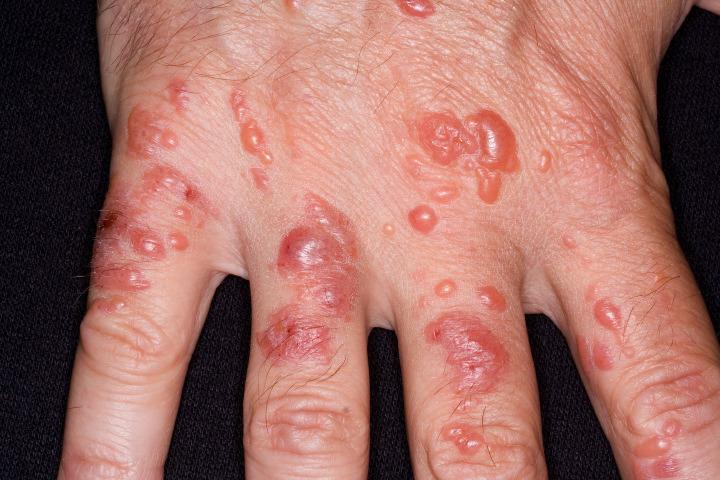 Почему не проходит контактный дерматит thumbnail