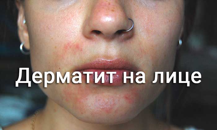 проблемы с кожей на лице