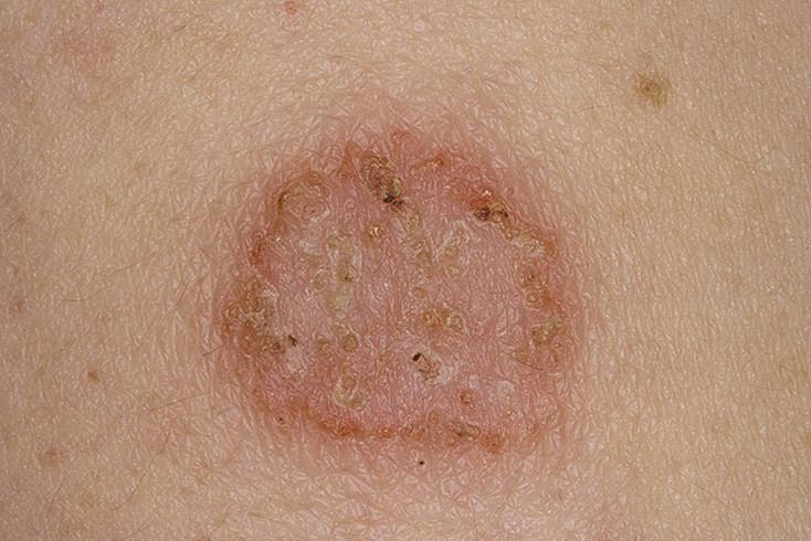 Монетовидная экзема: причины и лечение у детей и взрослых