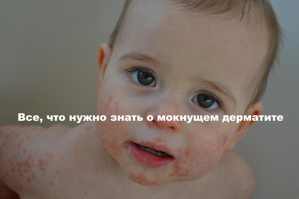 Лицо малыша, покрытое красными точками