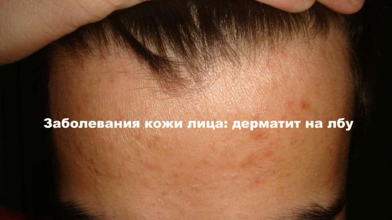 Дерматит на лице (лбу, бровях, подбородке): способы лечения