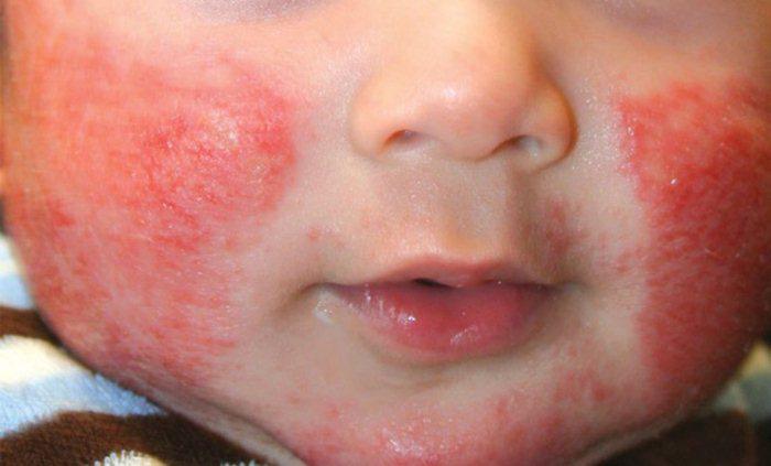 Проявление аллергии на клубнику у ребенка 