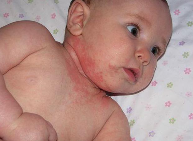 Аллергия у ребенка на кукурузу