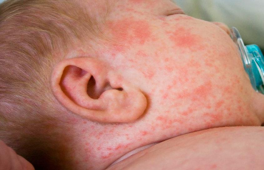 Сыпь у ребенка во время аллергии на брокколи