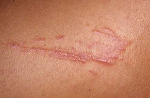 Аллергический дерматит на коже